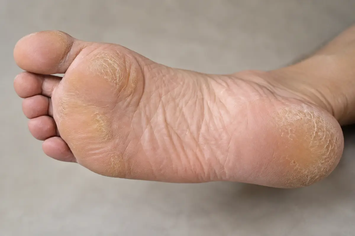 Visual kematu dan kulit menebal pada tapak kaki