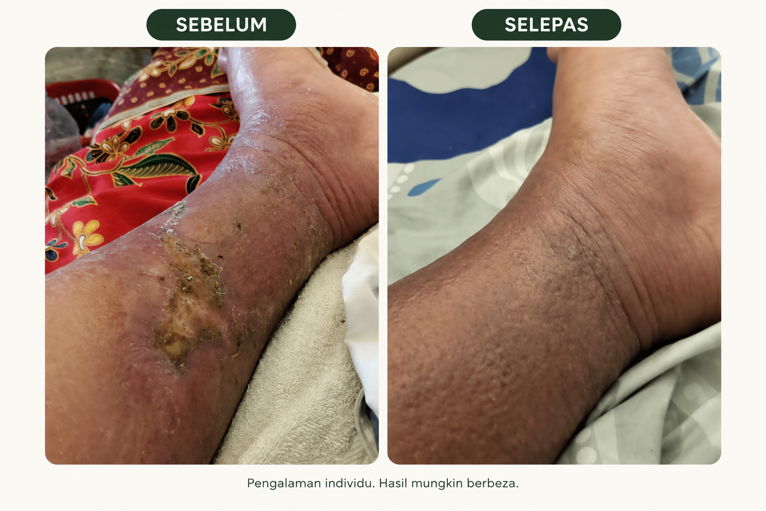 Perbandingan keadaan kaki sebelum dan selepas yang dikongsi oleh seorang pelanggan