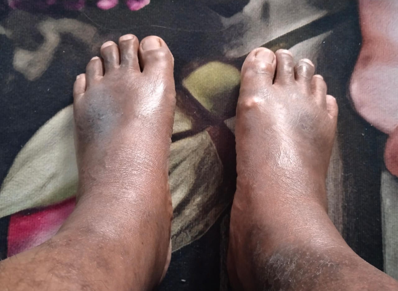 Kaki pelanggan selepas rutin Vitacare: kulit lebih licin dan lembap
