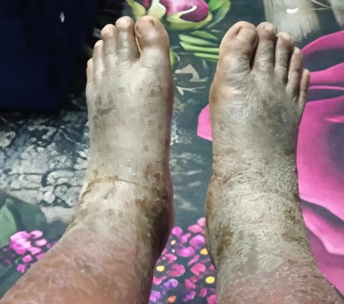 Kaki pelanggan sebelum rutin Vitacare: kulit kering, bersisik dan merekah