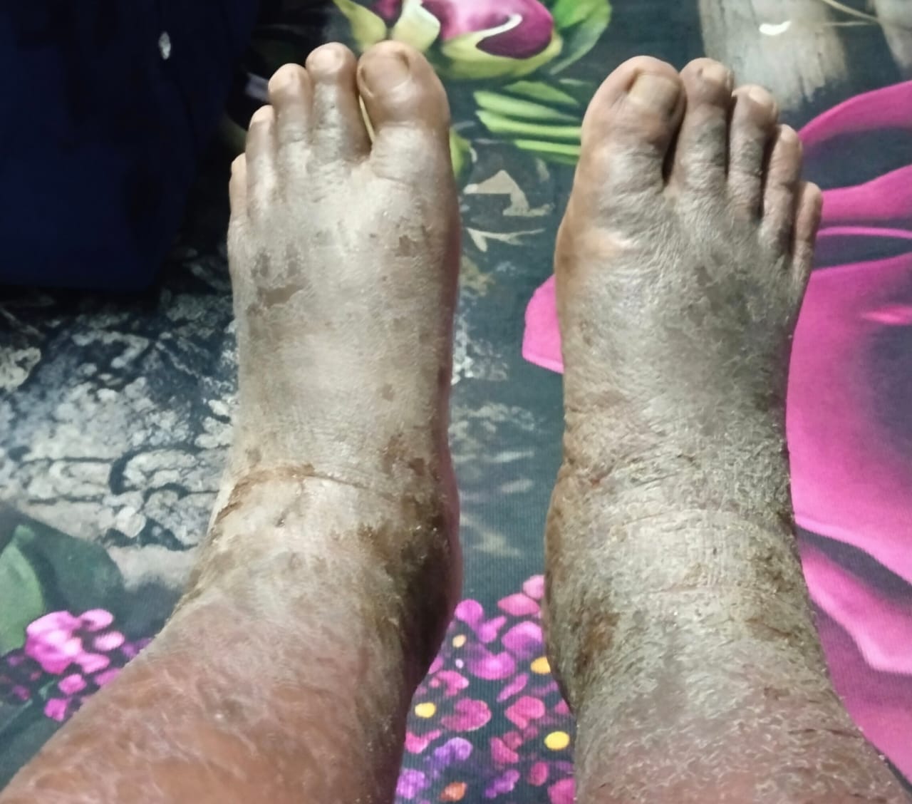 Kaki pelanggan sebelum rutin Vitacare: kulit kering, bersisik dan merekah