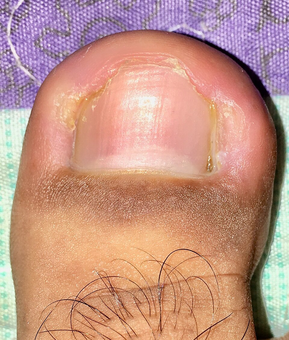Foto sebenar kuku cengkam pada ibu jari kaki