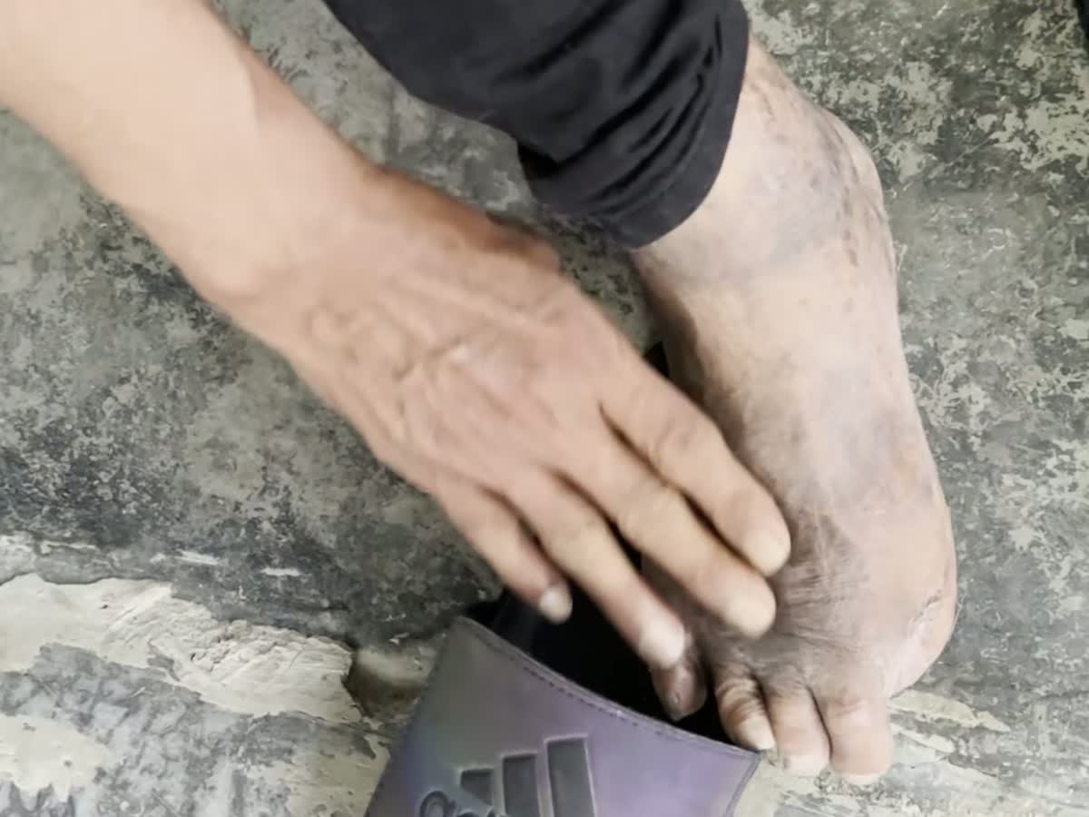Foto sebenar kulit kaki yang kering dan menggelupas