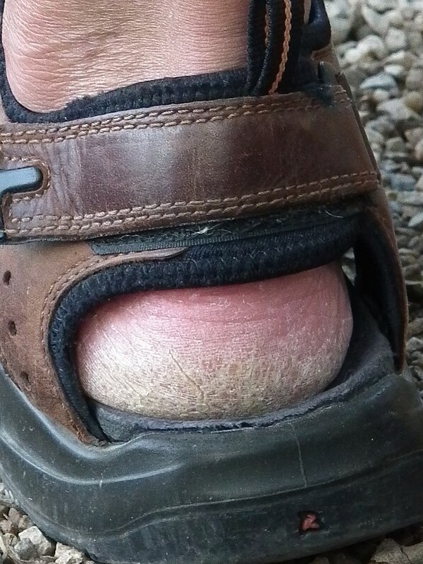 Tumit sebenar yang kering dan merekah di dalam sandal